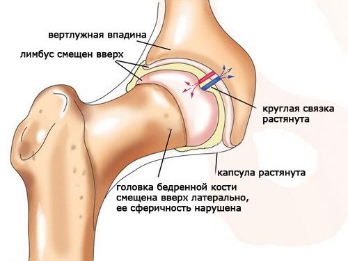 Строение больного тазобедренного сустава человека