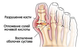 Воспаленный сустав разрушают соли мочевой кислоты