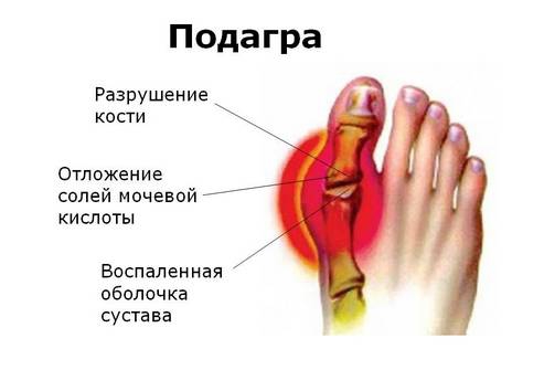 Проявление болезни Сустав разрушается от солей мочевой кислоты