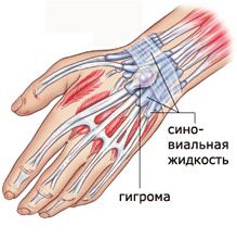 Новообразование В новообразовании скапливается синовиальная жидкость