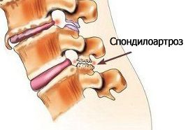 Спондилоартроз Разрушение звена между позвонками приводит к потере стабильности позвоночника
