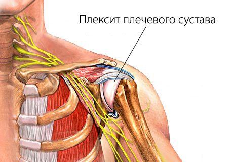 Воспаление в плече Неврологическое заболевание выражается поражением ствола плечевого сплетения