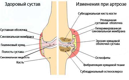 Здоровый и больной суставы Воспаление хрящевой ткани приводит к травме костей сустава и их постепенному разрушению