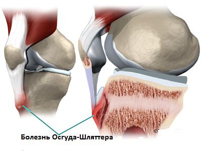 Болезнь Осгуда-Шляттера Болезнь Осгуда-Шляттера может возникнуть у подростков в период резкого роста