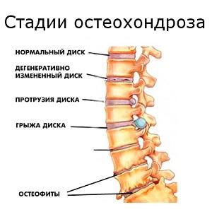 Виды изменений в позвоночнике у больного остеохондрозом Деструктивные изменения дисков и позвонков