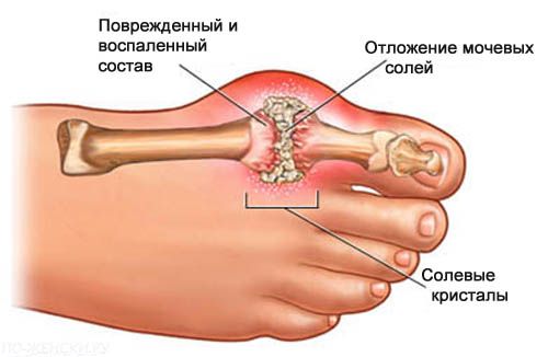 Больной сустав В больном суставе накапливаются кристаллы мочевой кислоты и разъедают хрящевую ткань