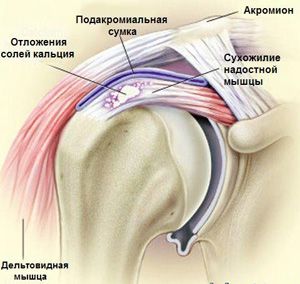 Отложение солей в суставе Причина нарушений - отложение солей