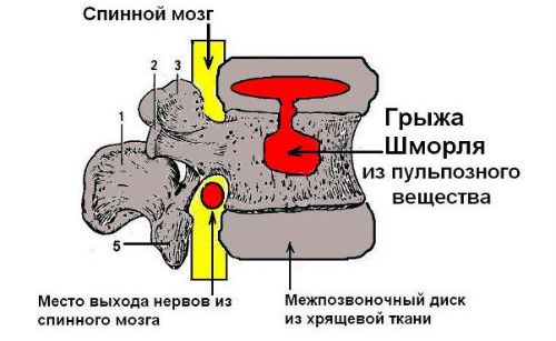 Как выглядит эта патология позвоночника Диагностируют такую грыжу с помощью рентгена или КТ