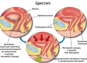 Воспаление мочевого пузыря