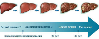 Развитие болезни печени