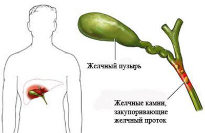 Желчные камни при холецистите