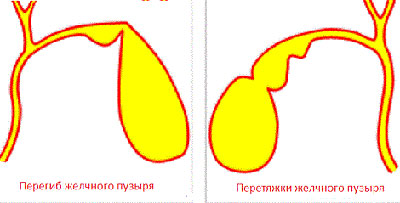 Перегиб желчного пузыря