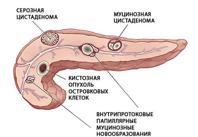 Кисты поджелудочной железы