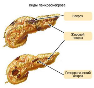 панкреонекроз