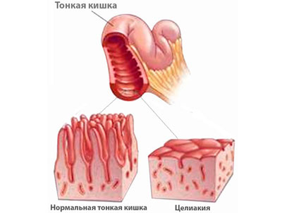 Болезнь тонкой кишки