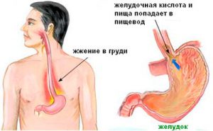 когда возникает изжога