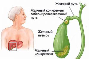 желчекаменная болезнь