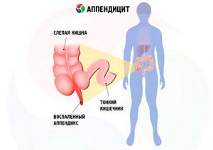 что такое аппендицит