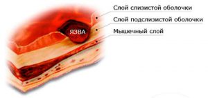 язва желудка