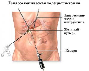 лапароскопическая холецистэктомия