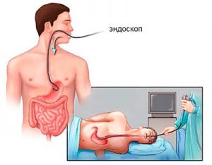 гастроскопия