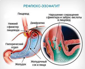 эзофагит