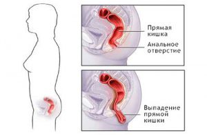 как выглядит выпадение прямой кишки