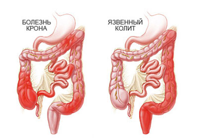 крон и колит