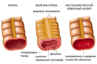 Язвенный колит