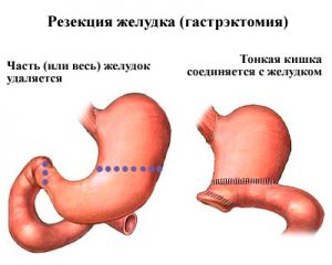 Гастрэктомия