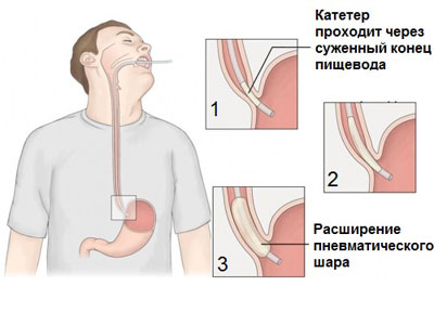 способ лечения