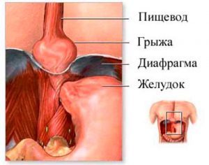 грыжа желудка
