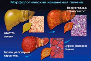 Причины и лечение зуда кожи тела при заболеваниях печени