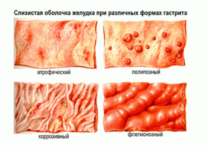 слизистая желудка при гастрите
