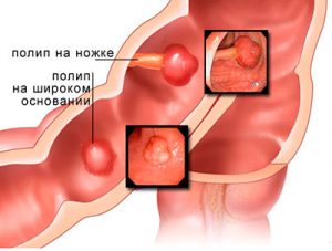полипы на стенках кишечника