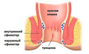 трещина прямой кишки