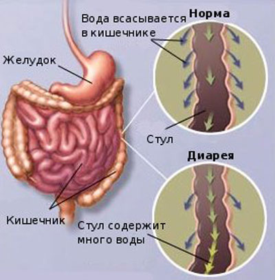 обезвоживание при диарее