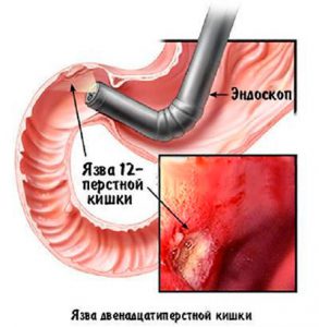 язвенная болезнь