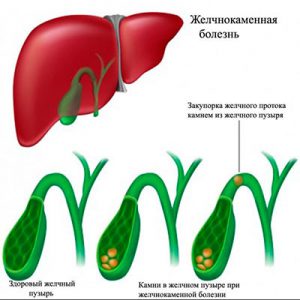 камни в желчном пузыре