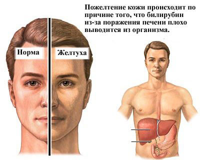 желтуха у мужчины