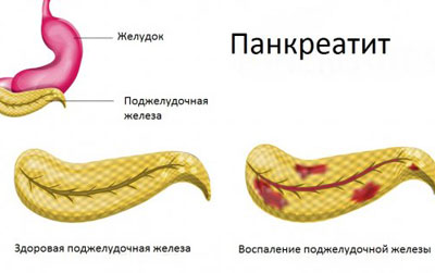Воспаление поджелудочной железы