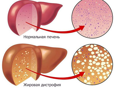 Дистрофия печени