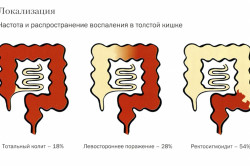 Локализация и распространенность колита