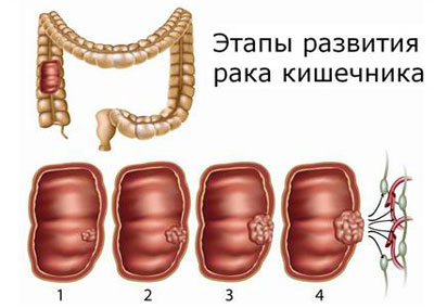 Стадии рака кишечника