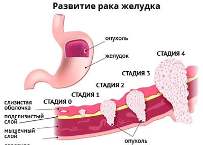 Стадии рака желудка