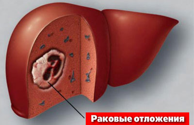 Раковая опухоль в печени