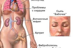 Симптомы заболевания системная красная волчанка Симптомы заболевания системная красная волчанка