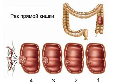 Рак прямой кишки