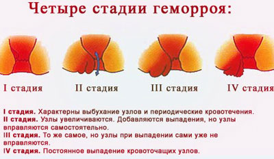Стадии геморроя