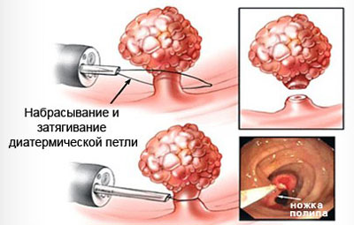 Удаление полипа